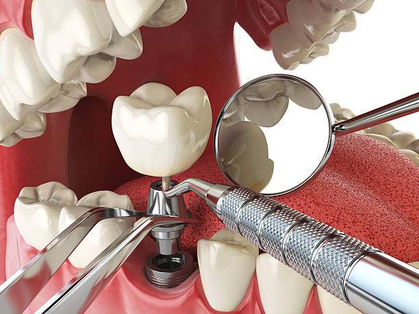 Best Broken or Chipped Tooth Repair in Valrico, FL